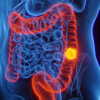 Des scientifiques identifient des cellules immunitaires à l’origine de cancers