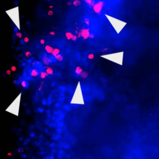 Syndrome des ovaires polykystiques : un nouveau regard sur les rouages d’un trouble complexe