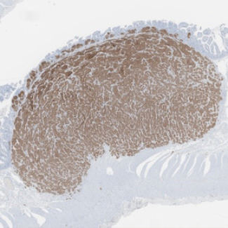 Vers une médecine de précision pour les tumeurs neuroendocrines de l’intestin grêle